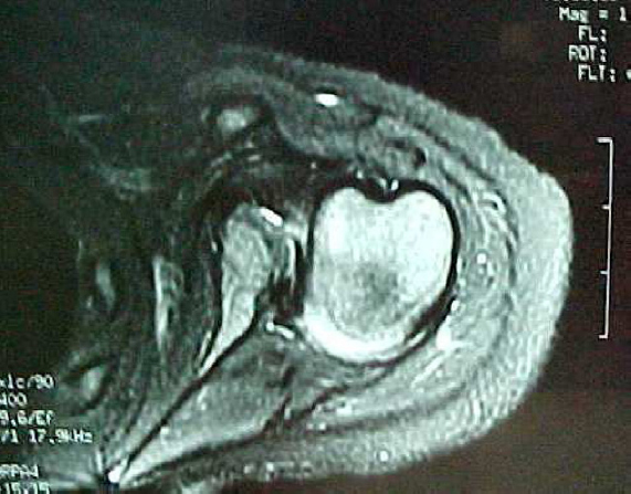 BE Centering osteotomy for treatment