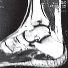 BE Lesão osteocondral central da tíbia distal. Relato de caso e revisão da literatura