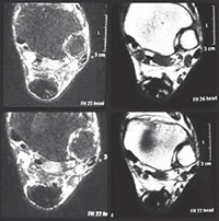 BE Ossificação heterotópica do tendão calcâneo relato de caso Heterotopic ossification of the Achilles tendon