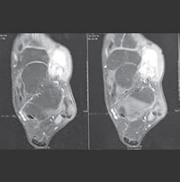 BE Tumor de células gigantes da bainha sinovial do tendão do extensor curto dos dedos do pé relato de caso