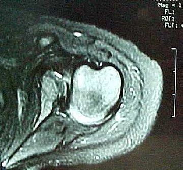 Centering osteotomy for treatment of posterior shoulder dislocation in obstetrical palsy