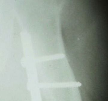 New Minimally Invasive Bridge-Plate Technique for Treatment of Atrophic Humeral Shaft Nonunion