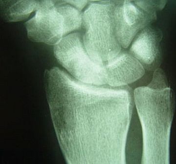 Treatment of scaphoid nonunion with vascularised and nonvascularised dorsal bone grafting from the distal radius