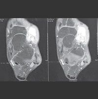 Tumor de células gigantes da bainha sinovial do tendão do extensor curto dos dedos do pé: relato de caso